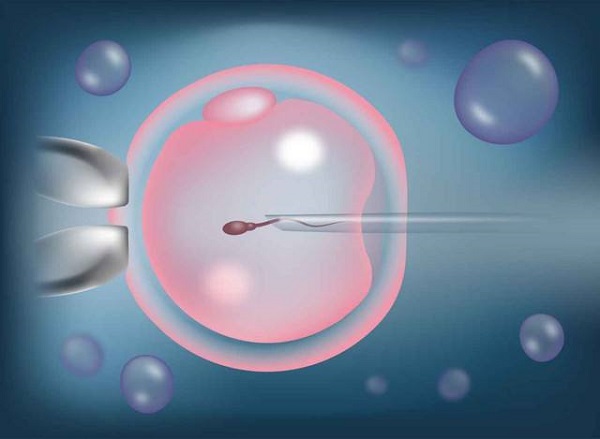 In Vitro Fertilization